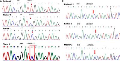 Duchenne Muscular Dystrophy With Low Acidic α-Glucosidase Activity: Two Case Reports and Literature Review